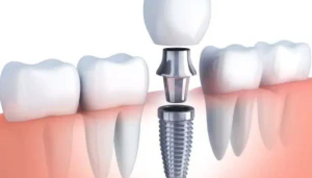 Are Dental Implants Painful?