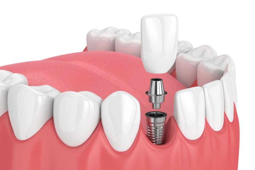 Dental implant