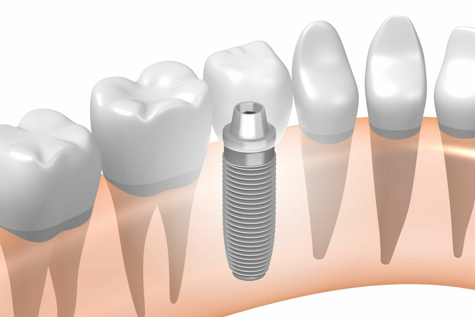 dental implant