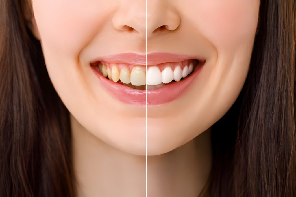 Teeth Whitening