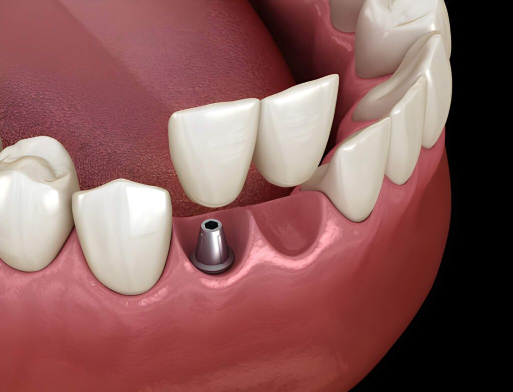 Dental Implant