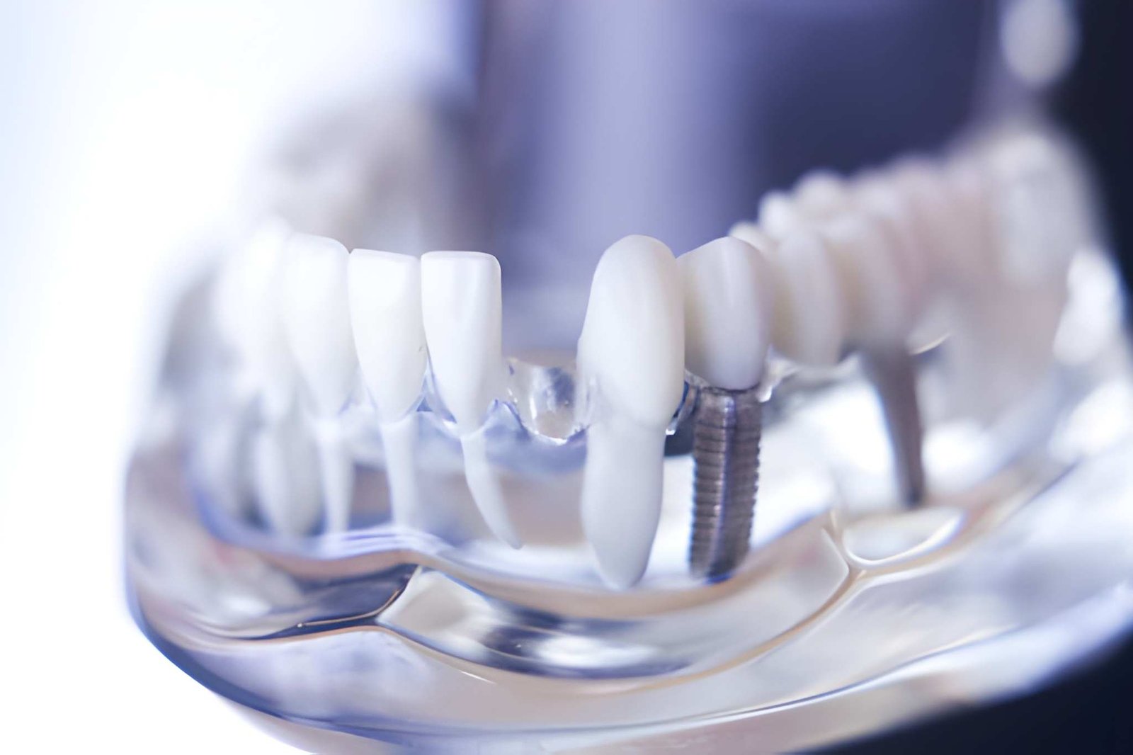 dental implant