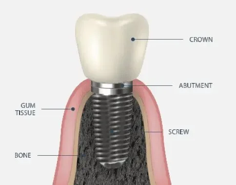 Cosmetic Dental Implants Treatment in Dumbarton