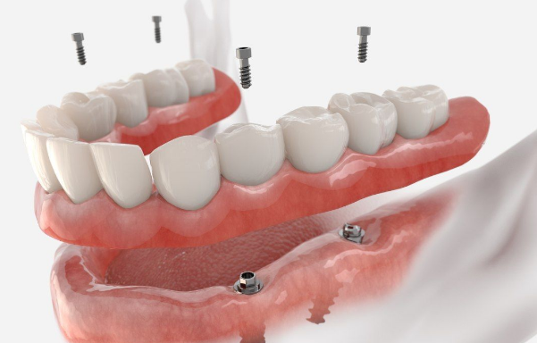 Strong teeth Dental Implants Treatment in Dumbarton