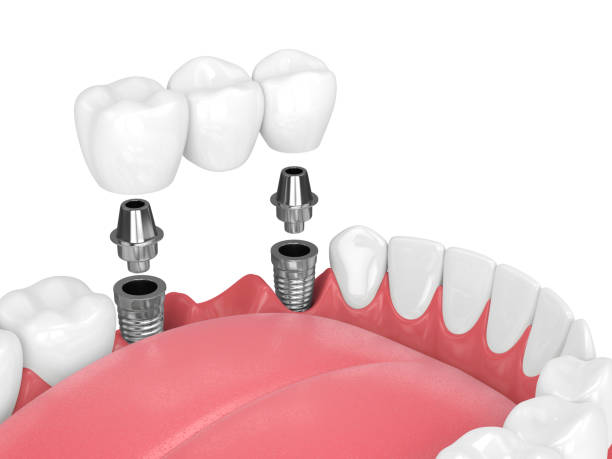 Dental Implants in Dumbarton: Alternatives, Benefits, and Considerations
