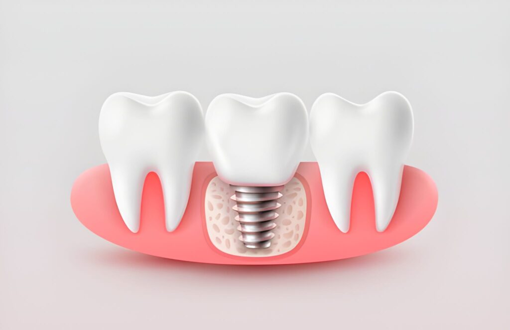 Dental Implants