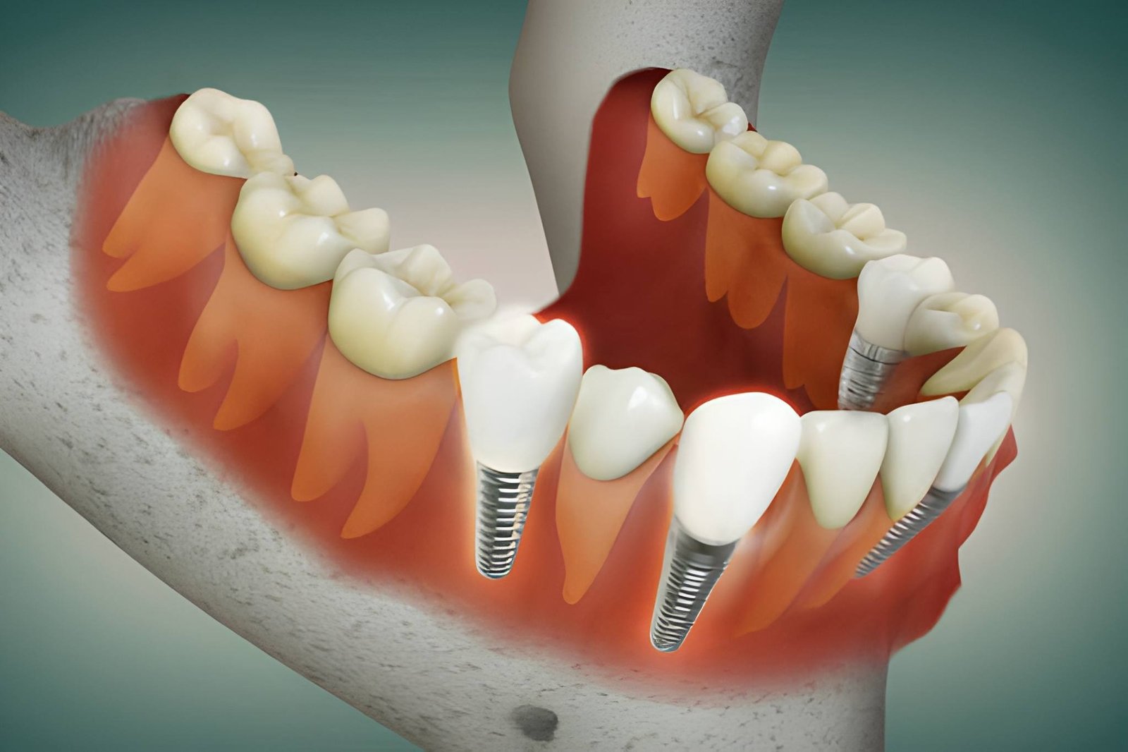 Thinking About Dental Implants in Dumbarton? Here’s What to Know