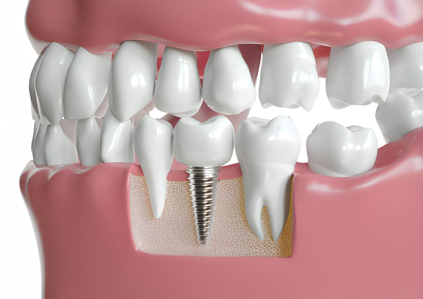 Thinking About Dental Implants in Dumbarton? Here’s What to Know
