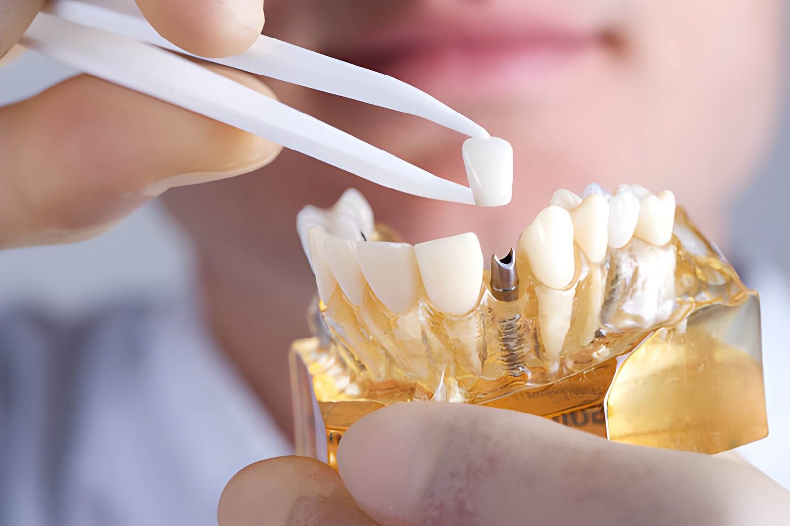 Dental Implants in Dumbarton: How They Support Long-Term Oral Health